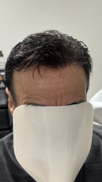 Homme de face avec complément capillaire posé, rendu naturel avec cache visage – Capillexpert